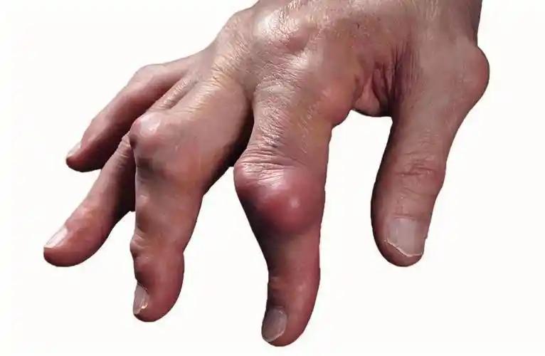 痛风与吃鱼有关？医生劝告：尿酸高的人，平时饮食避免“5细节”(图9)