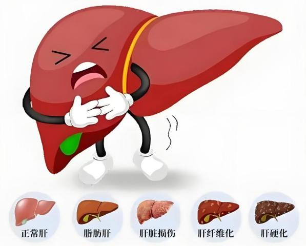 体重没超标，肝脏咋先告急了？(图3)