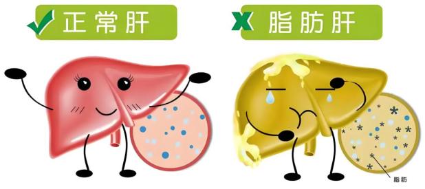 体重没超标，肝脏咋先告急了？(图4)