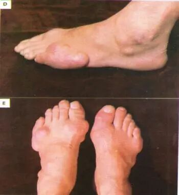 知多D | 主打一个开心！这些食物痛风患者都可以吃！但要注意→(图2)