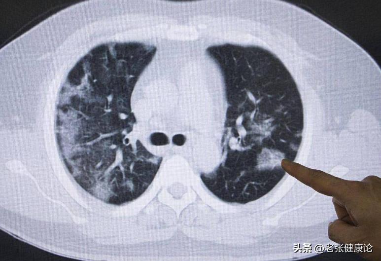 调查得知：一旦患上了肺癌，就不要吃这些东西了，千万别害了自己(图2)