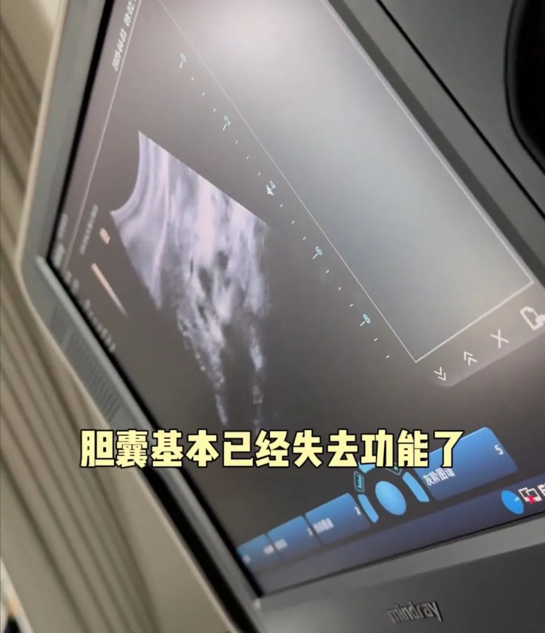 36岁知名女演员确诊！“已基本失去功能”(图2)