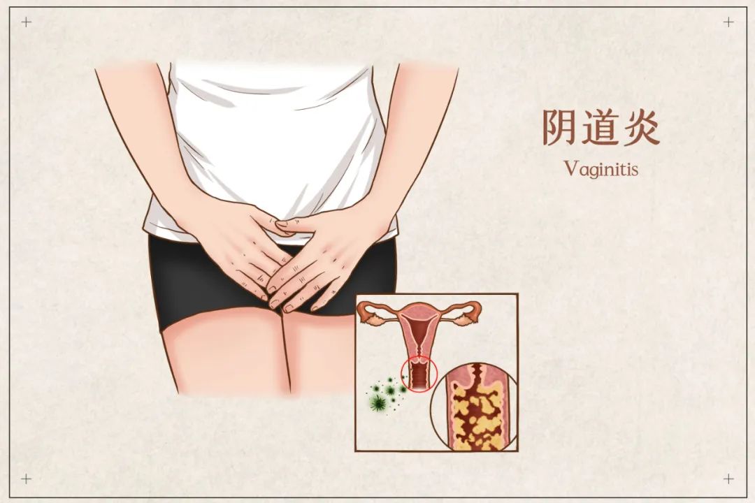 这样避孕易得妇科病？“腥”味大姐走进诊室，老公当场……(图3)