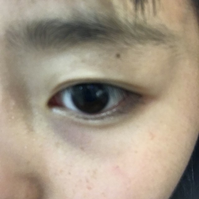 荔枝美小程序：告别“熊猫眼”，这些去黑眼圈妙招你知道吗？(图2)