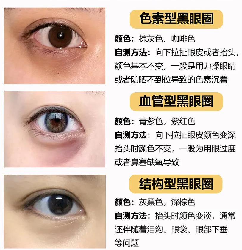 一眼看穿你的黑眼圈！3种类型自测指南(图2)