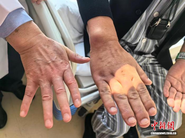 成年后鞋码还在长？别只当“发福” 专家：当心肢端肥大症